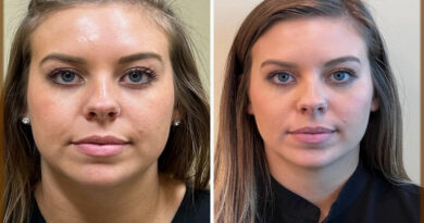 How to Get Rid of Wrinkles at home easily