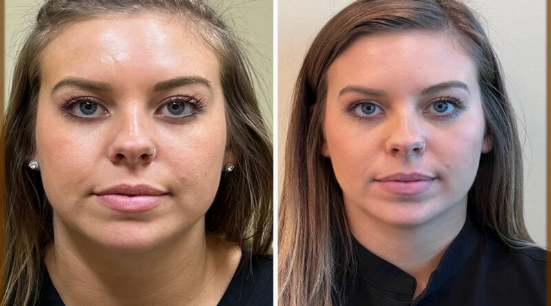 How to Get Rid of Wrinkles at home easily